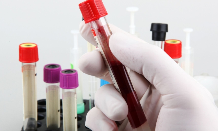Z analizo krvi zdaj mogoče določiti biološko starost možganov